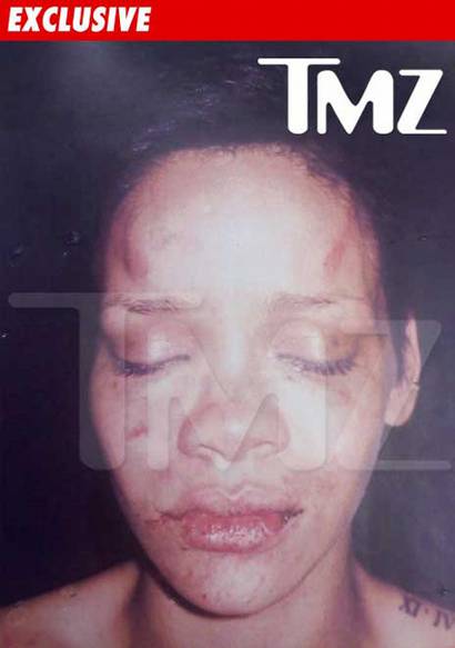 Bruised Rihanna
